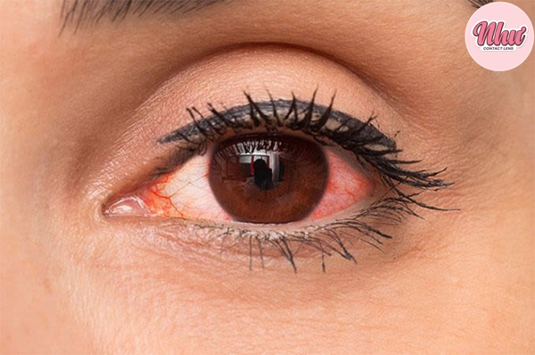 Cung cấp thiếu oxy cho mắt có thể gây ra những tác hại nghiêm trọng